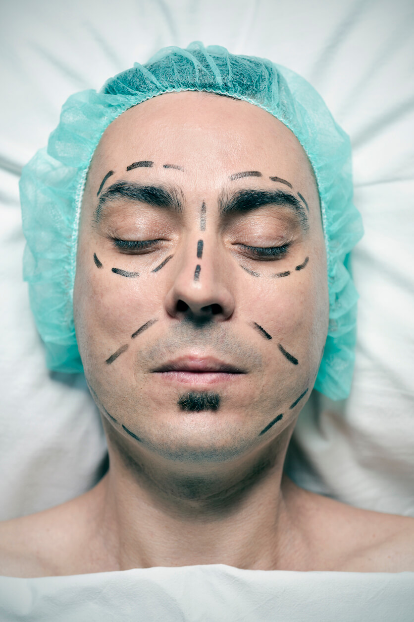 rinoplastia en hombres